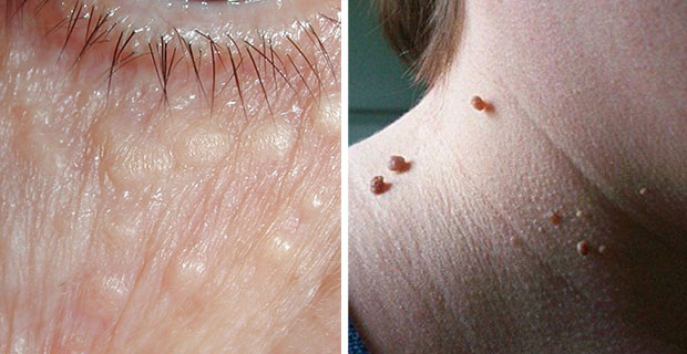 Thermocoagulation eliminates skin tags