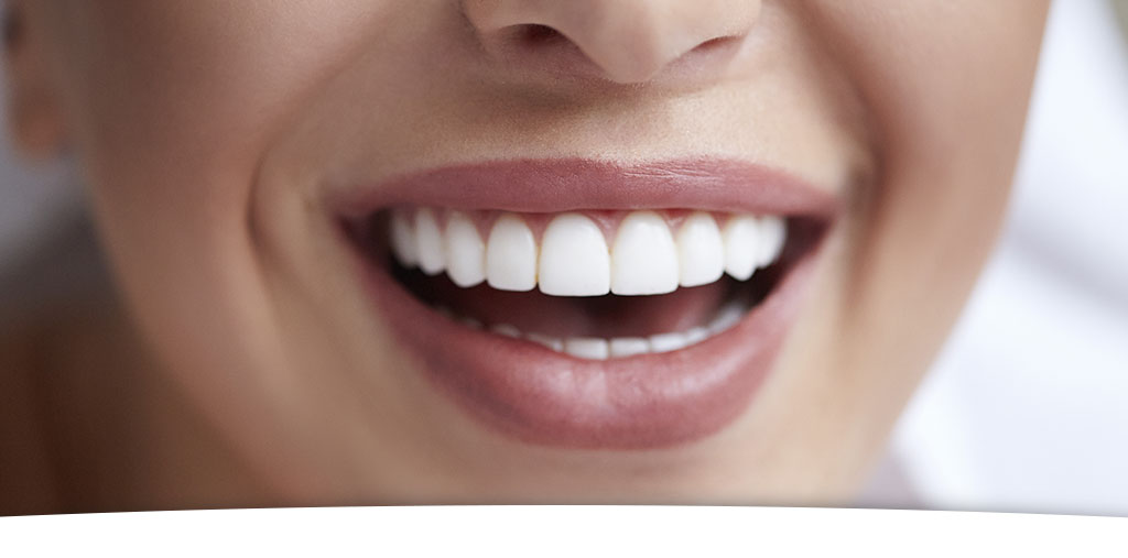 Professional teeth whitening