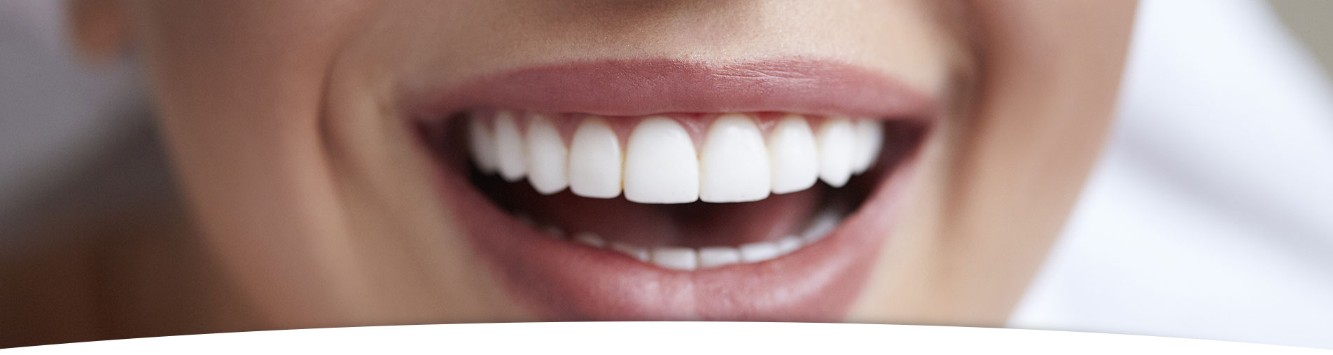 Professional teeth whitening