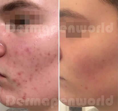 Microaiguillage Dermapen4