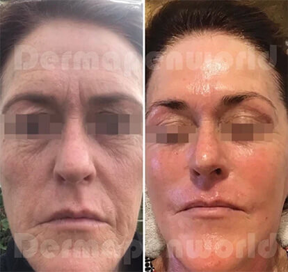 Microaiguillage Dermapen4