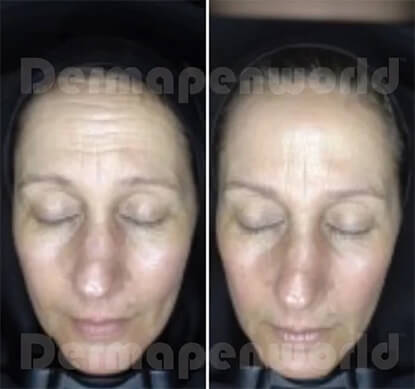 Microaiguillage Dermapen4