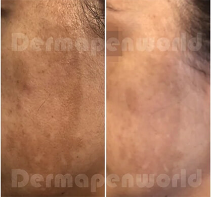 Microaiguillage Dermapen4