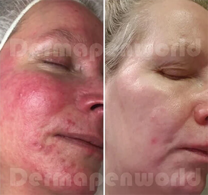 Microaiguillage Dermapen4