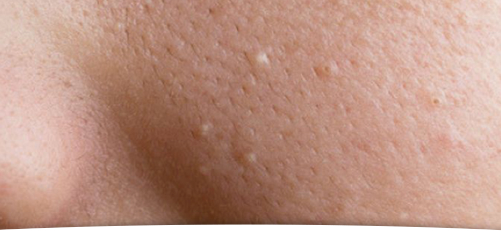 Treatment of acne and its scars