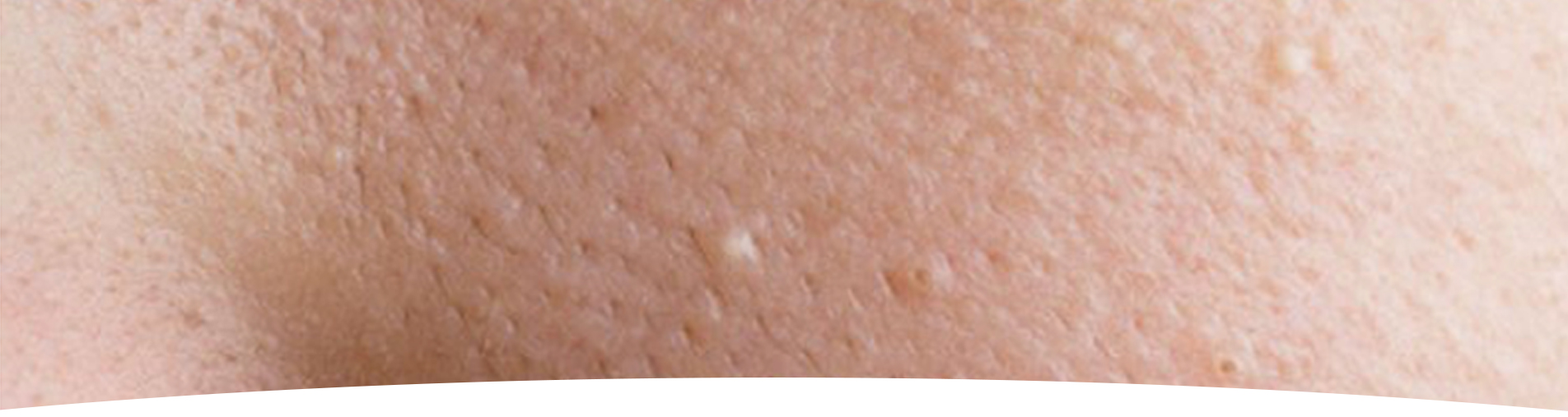 Treatment of acne and its scars