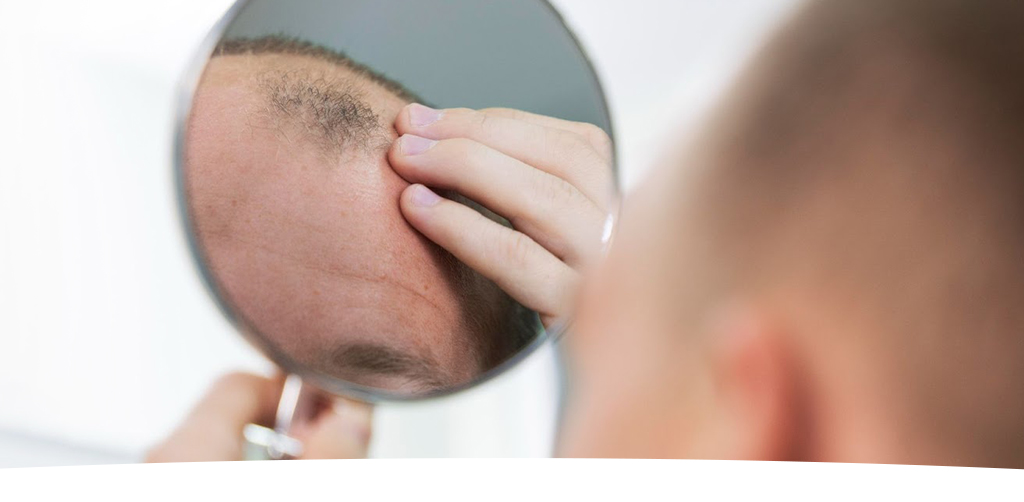 Perte de cheveux