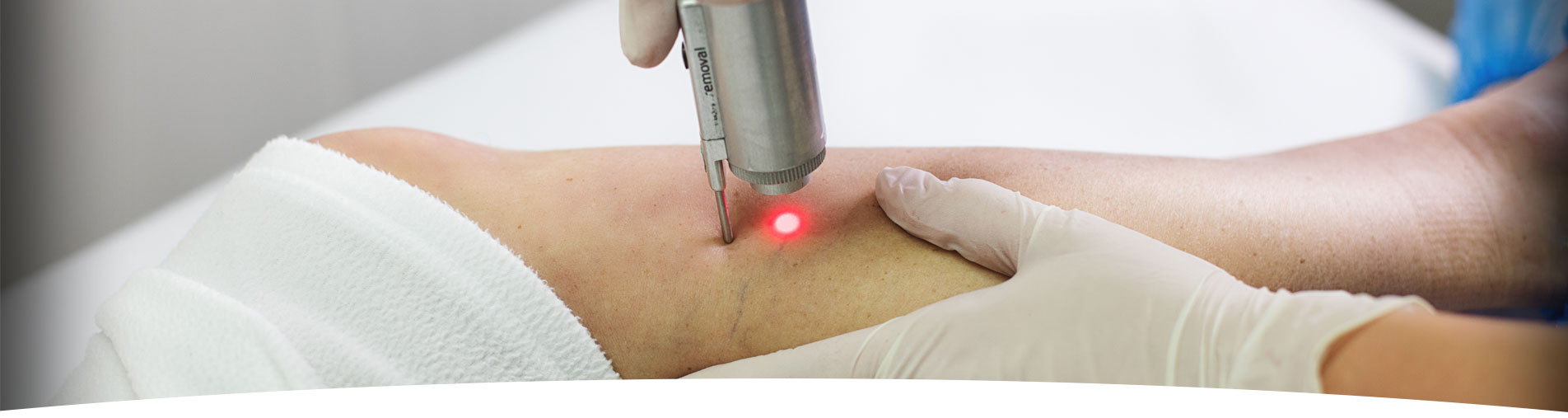 Laser treatment for varicose veins