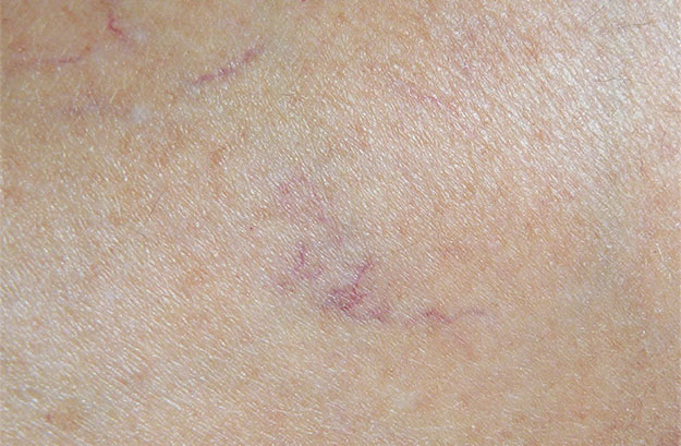 Varicose veins